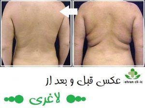 عکس قبل و بعد از لاغری