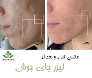 عکس قبل و بعد از لیزر جای جوش