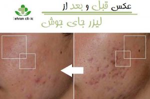 عکس قبل و بعد از لیزر جای جوش