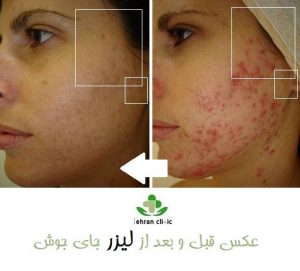 عکس قبل و بعد از لیزر جای جوش