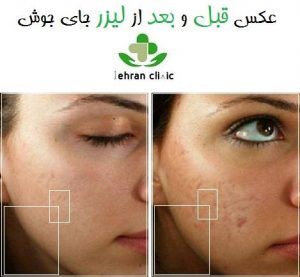 عکس قبل و بعد از لیزر جای جوش