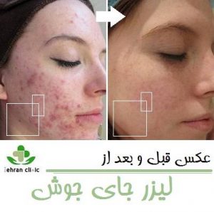 عکس قبل و بعد از لیزر جای جوش