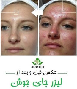عکس قبل و بعد از لیزر جای جوش