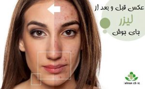عکس قبل و بعد از لیزر جای جوش