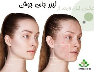 عکس قبل و بعد از لیزر جای جوش