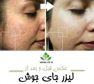 عکس قبل و بعد از لیزر جای جوش