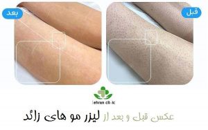 عکس قبل و بعد از لیزر مو های زائد