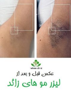 عکس قبل و بعد از لیزر مو های زائد