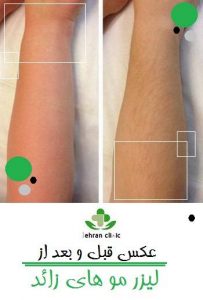 عکس قبل و بعد از لیزر مو های زائد
