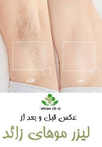 عکس قبل و بعد از لیزر موهای زائد