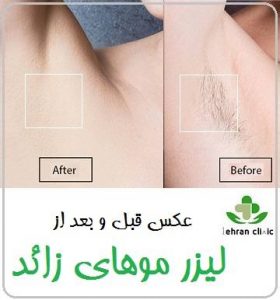 عکس قبل و بعد از لیزر موهای زائد