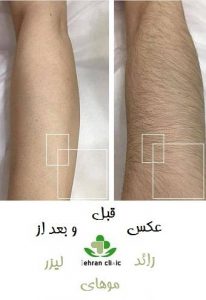 عکس قبل و بعد از لیزر موهای زائد