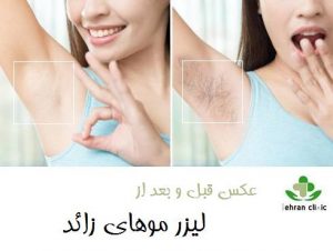 عکس قبل و بعد از لیزر موهای زائد