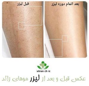 عکس قبل و بعد از لیزر موهای زائد