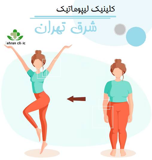 کلینیک لیپوماتیک شرق تهران