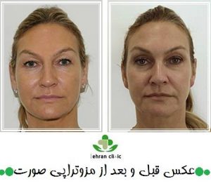 عکس قبل و بعد از مزوتراپی صورت