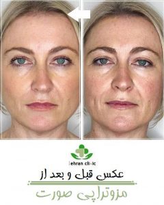 عکس قبل و بعد از مزوتراپی صورت
