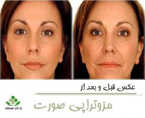 عکس قبل و بعد از مزوتراپی صورت
