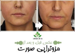 عکس قبل و بعد از مزوتراپی صورت