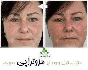 عکس قبل و بعد از مزوتراپی صورت