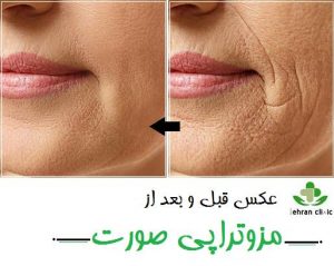 عکس قبل و بعد از مزوتراپی صورت
