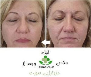 عکس قبل و بعد از مزوتراپی صورت