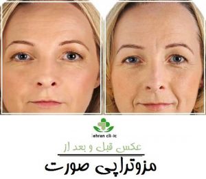 عکس قبل و بعد از مزوتراپی صورت