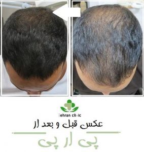 عکس قبل و بعد از پی ار پی