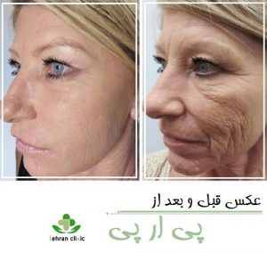 عکس قبل و بعد از پی ار پی