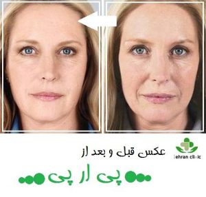 عکس قبل و بعد از پی ار پی