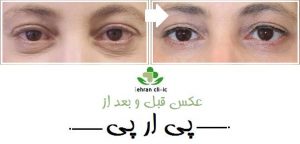 عکس قبل و بعد از پی ار پی