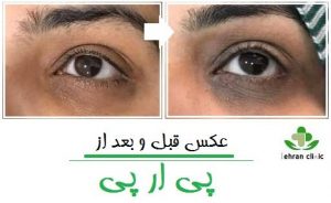 عکس قبل و بعد از پی ار پی