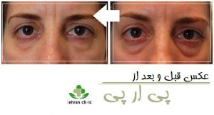 عکس قبل و بعد از پی ار پی