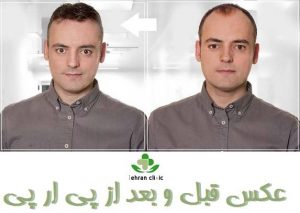 عکس قبل و بعد از پی ار پی