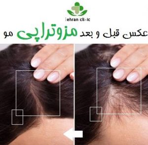 عکس قبل و بعد مزوتراپی مو