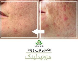 عکس قبل و بعد مزونیدلینگ