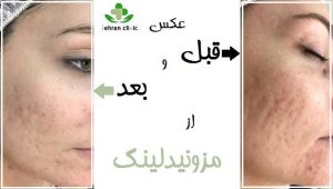 عکس قبل و بعد مزونیدلینگ