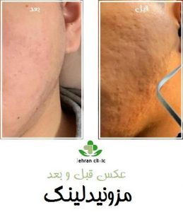 عکس قبل و بعد مزونیدلینگ