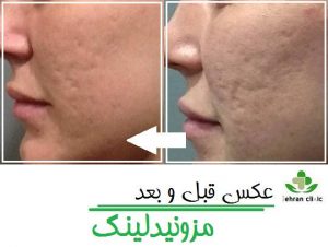 عکس قبل و بعد مزونیدلینگ