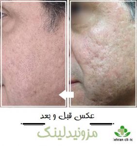 عکس قبل و بعد مزونیدلینگ