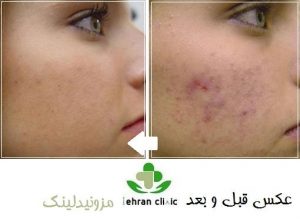 عکس قبل و بعد مزونیدلینگ