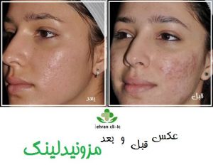 عکس قبل و بعد مزونیدلینگ