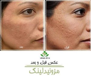 عکس قبل و بعد مزونیدلینگ