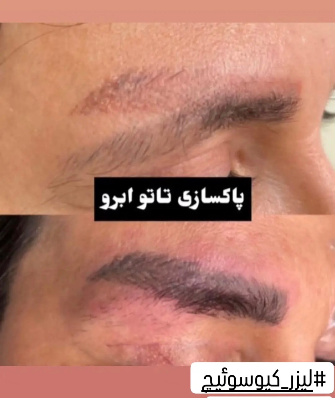 نمونه سوم نتیجه لیزر تاتو در تهران