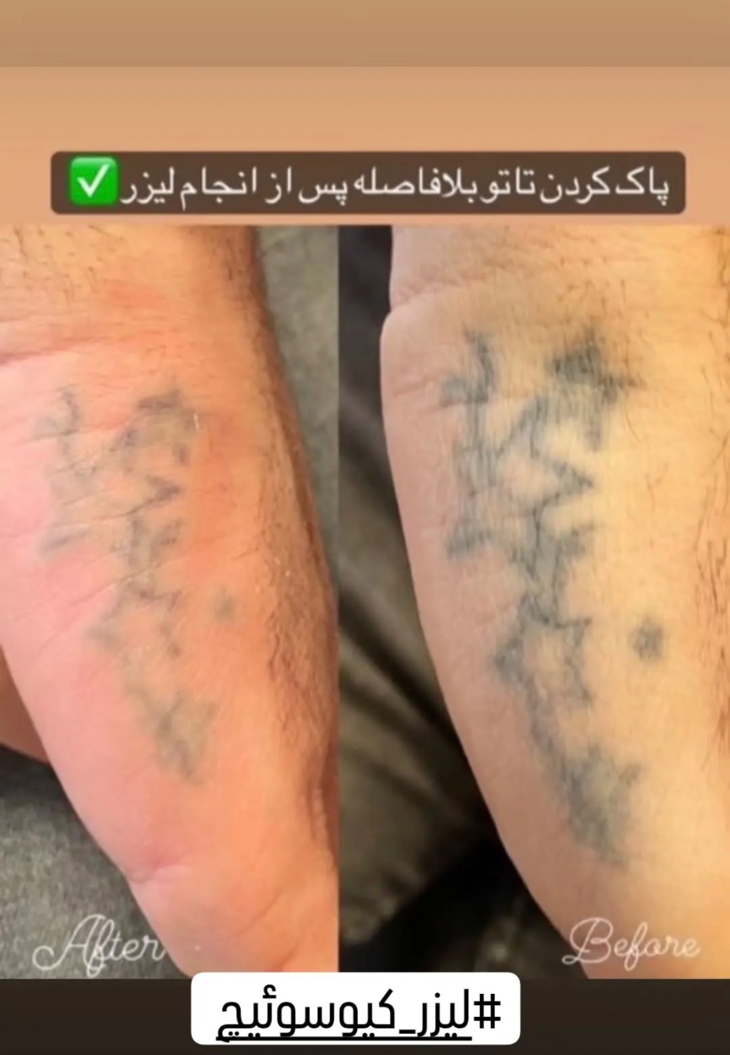 نمونه دوم عکس پاک کردن خالکوبی قبل و بعد از لیزر