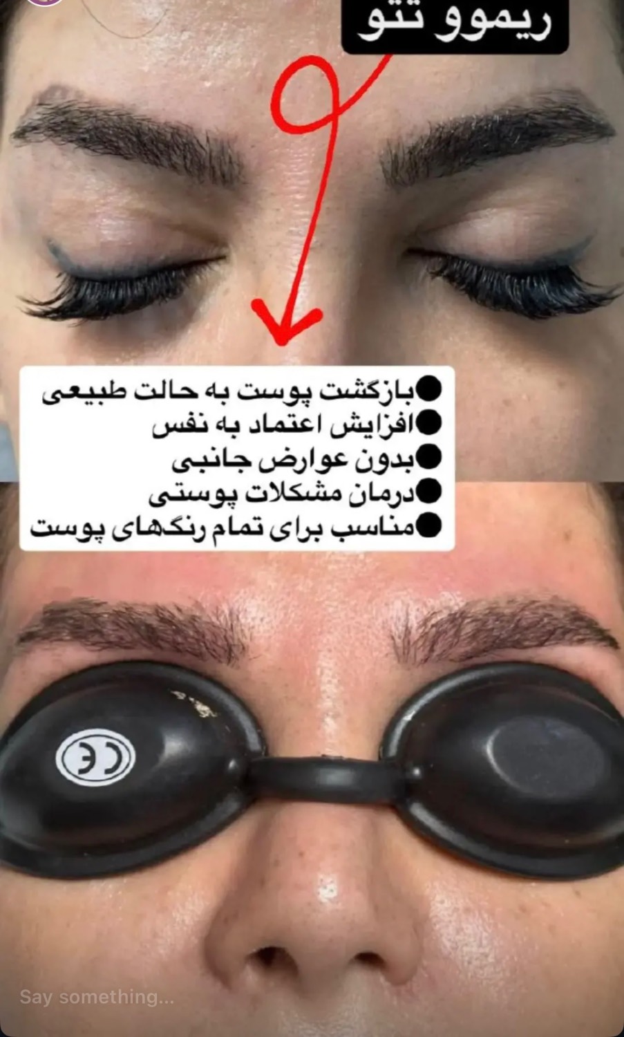 نمونه اول عکس قبل و بعد پاک کردن تاتو با لیزر کیوسوییچ