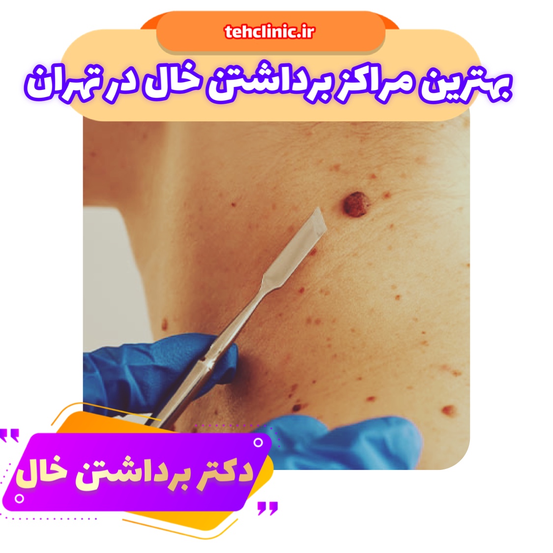 لیست 10 تا از بهترین دکتر برداشتن خال در تهران + آدرس شماره تماس ...