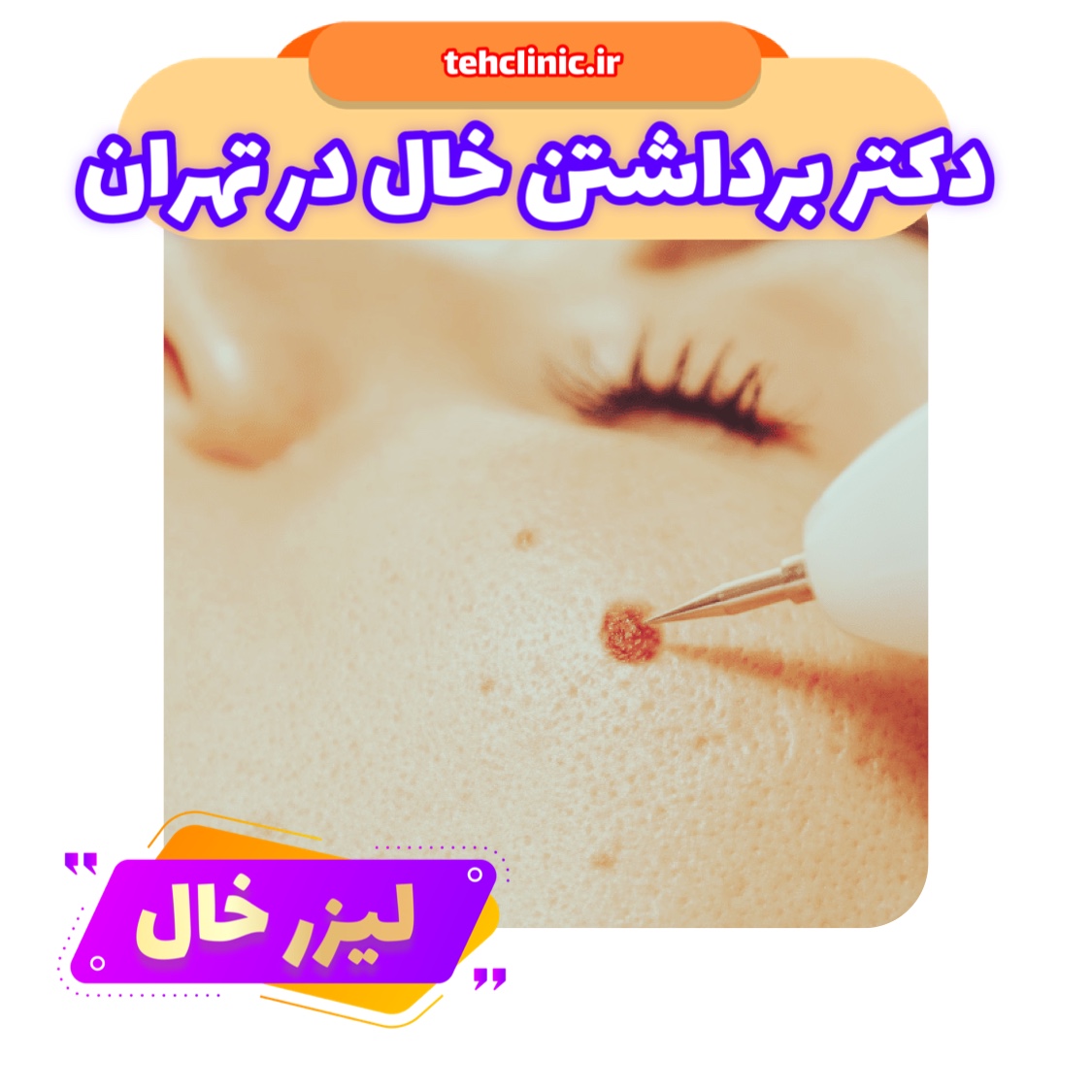 دکتر برداشتن خال در تهران