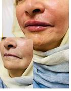 فیشیال و پاکسازی پوست نگارتیپس