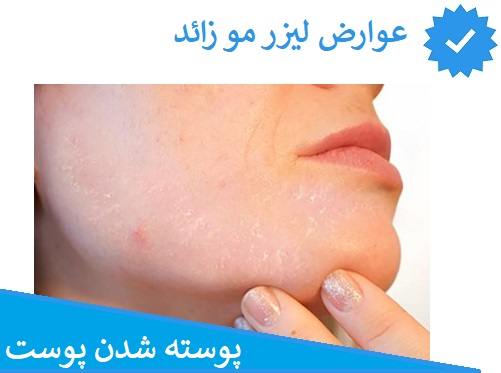 پوسته پوسته شدن از عوارض لیزر مو زائد